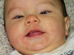 Csecsemőkori ételallergia és ételérzékenység: felismerés, különbségek